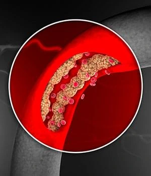 Illustration of a clogged artery representing reduced blood flow, a common contributor to male libido and performance decline